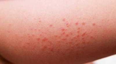 Что такое потница, как отличить её от аллергии или инфекции и нужно ли лечить
