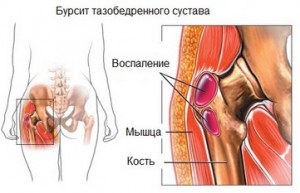 Массаж при бурсите тазобедренного сустава