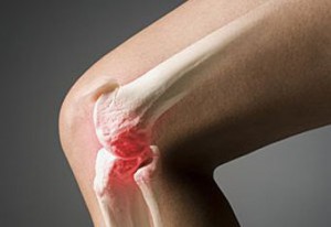 Лечение при артрозе коленного сустава