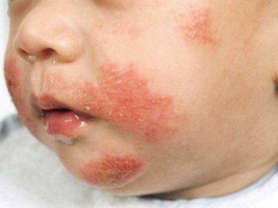 От чего бывает атопический дерматит у детей thumbnail